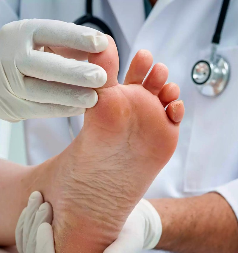 Verificar os sintomas dos pés joanetes